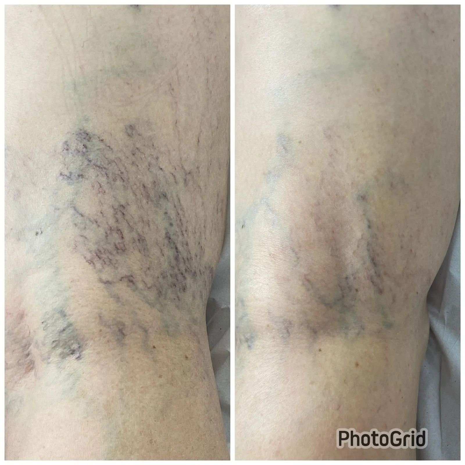 Antes e depois — resultado real do tratamento de vasinhos